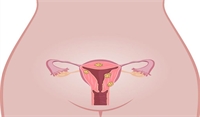 Hysterectomy or removal of the uterus