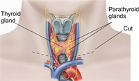 Early and late complications of thyroidectomy