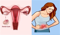 Symptoms of a ruptured ovarian cyst