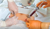 Bone marrow transplantation in Iran