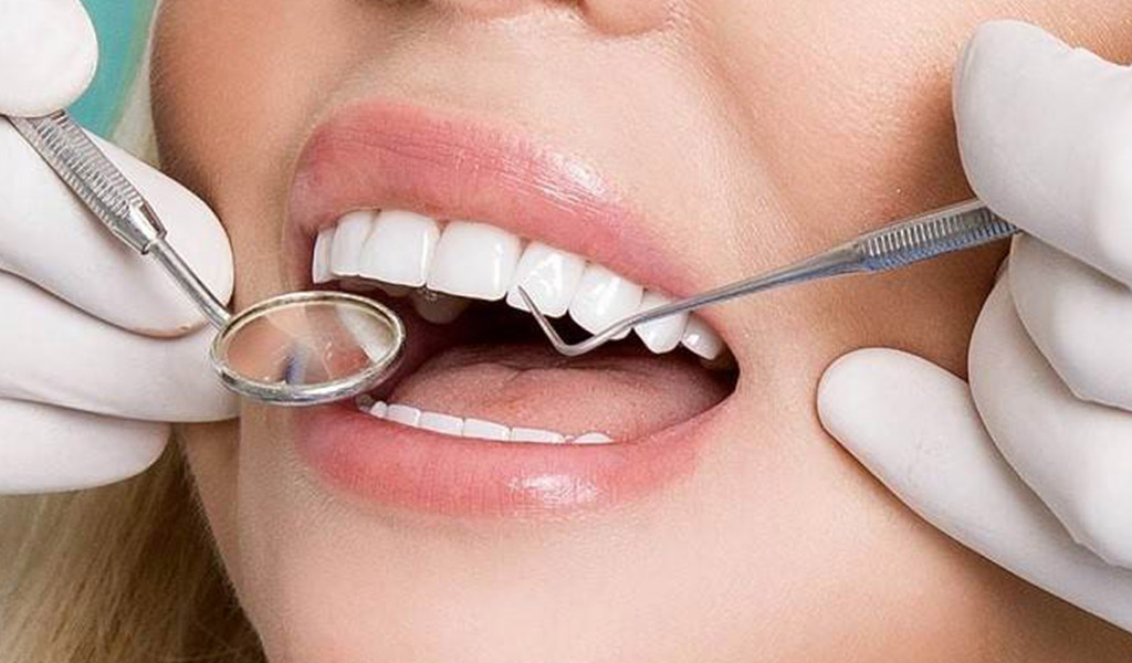 Dental laminates procedure