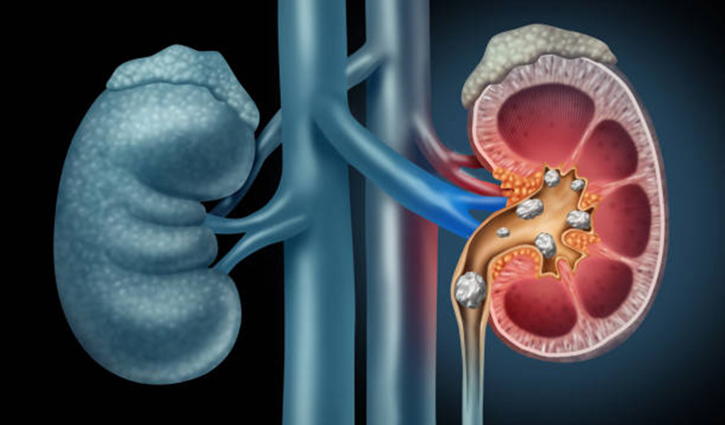 Kidney stone removal without surgery