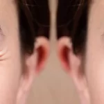 Blepharoplasty (plastic surgery)