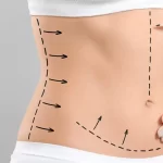 Lipomatic of abdomen and flanks