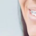 Smile Design Correction